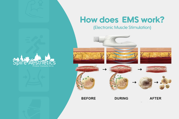 EMS treatment for post pregnancy weight loss treatment Worksop