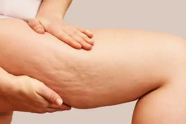 Image of woman showing leg with cellulite Worksop