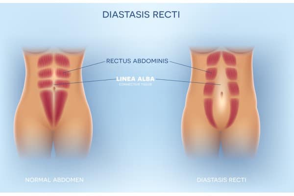 What Non-Surgical Options Are Available for Diastasis Recti Worksop?