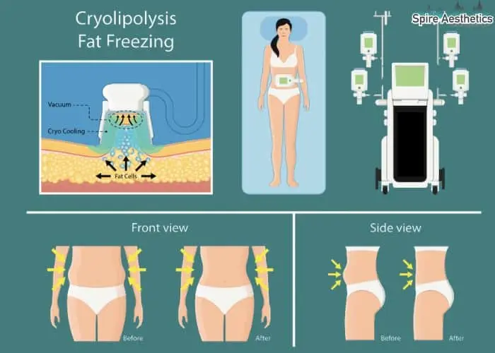Fat freezing treatment Worksop benefits for competitions to remove stubborn fat deposits.