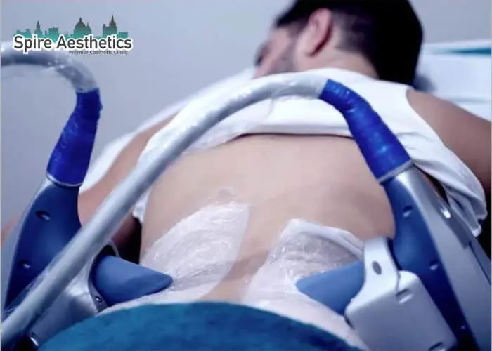 Man having fat freezing treatment done on love handles before a competitions Worksop to create a sculpted look.