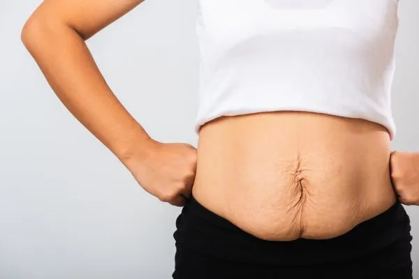 Image of a woman's stomach after weight loss with sagging skin following a gastric band Worksop