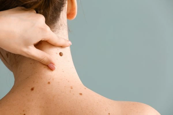 skin blemish removal Worksop treatment