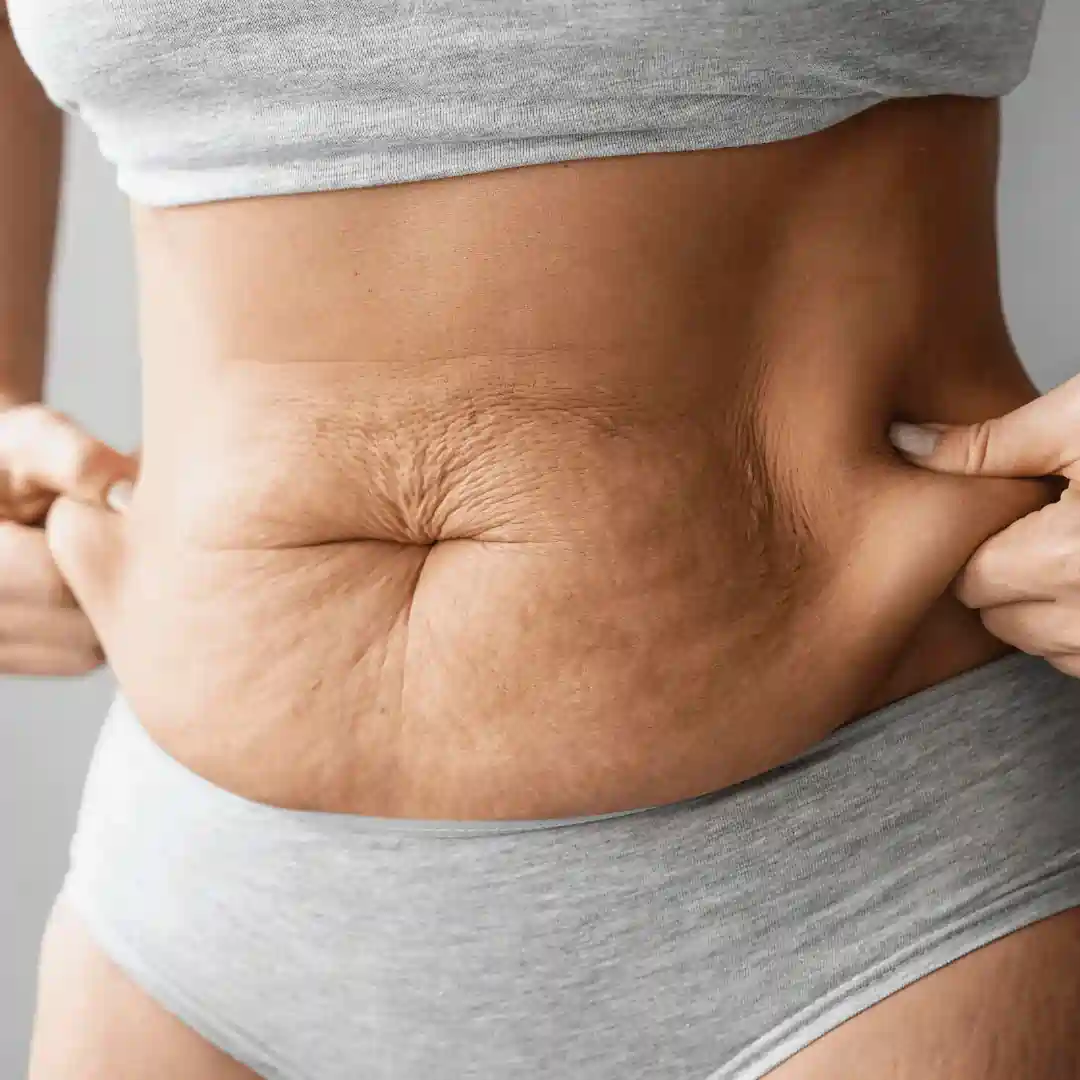 Is It Normal to Have Loose Skin After Pregnancy Worksop?