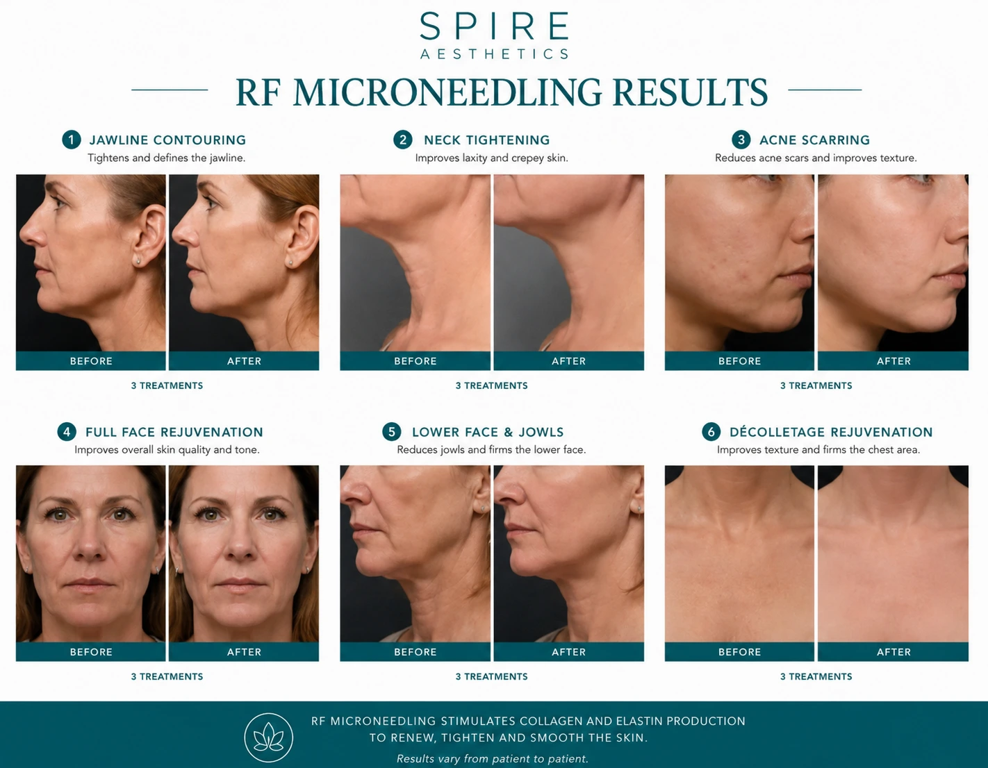 RF Microneedling Skin tightening Worksop results
