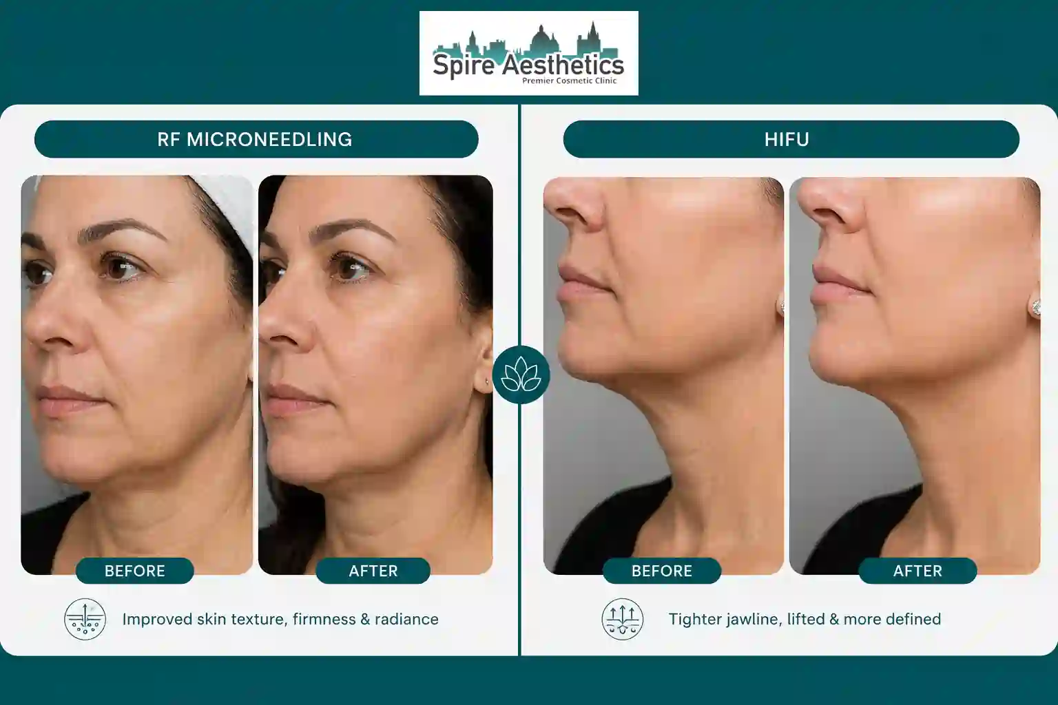 Can RF Microneedling and HIFU Be Combined Worksop?