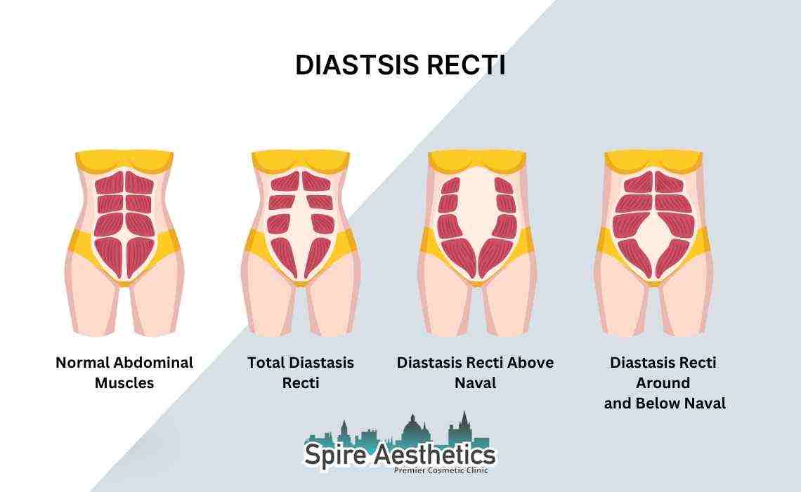 Is Non-Surgical Diastasis Recti Treatment Right for You? Common Concerns Answered Worksop